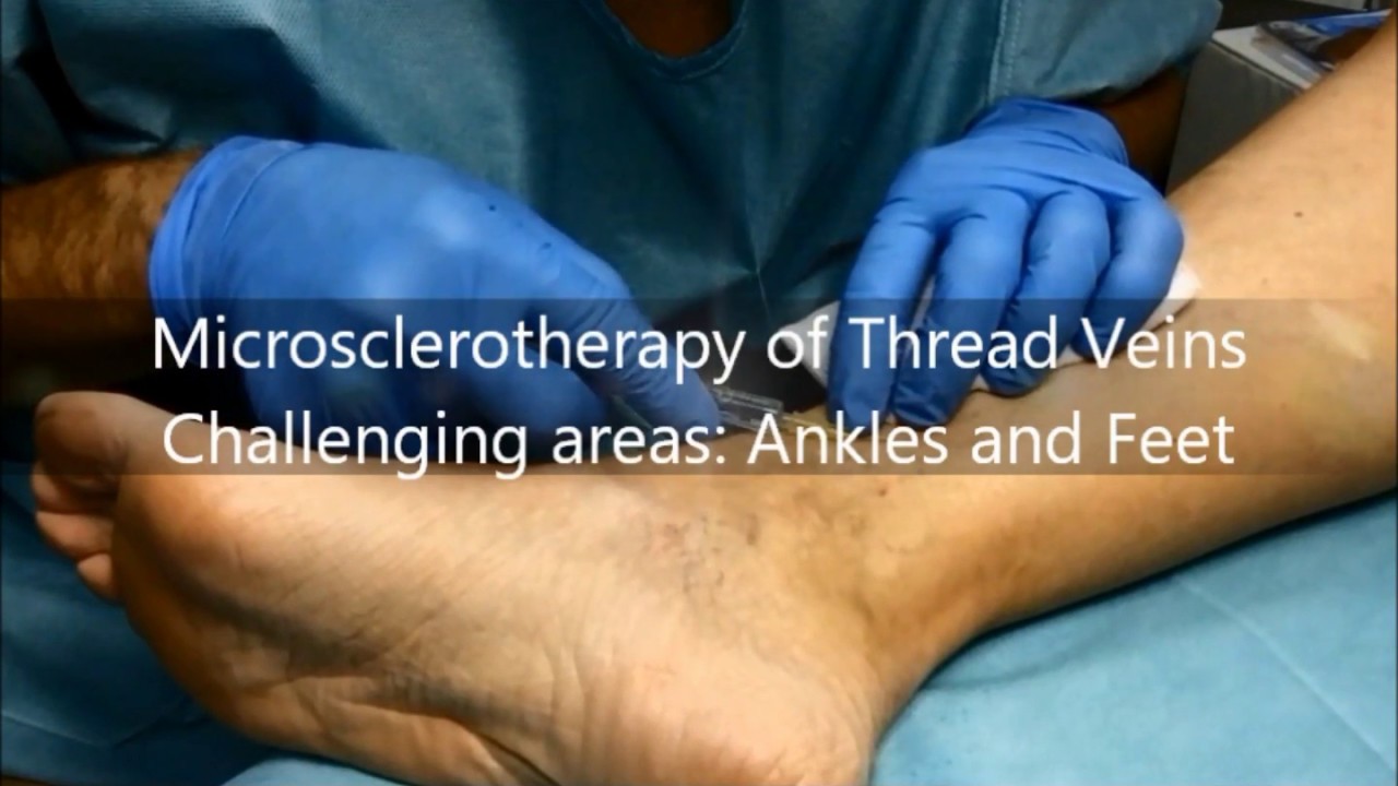 Microsclerotherapy Of Thread Veins Challenging Areas Ankles And Feet
