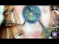 Lecture: Visualizing Cataract Surgery & Techniques: A Step-by-Step Surgical Walkthrough