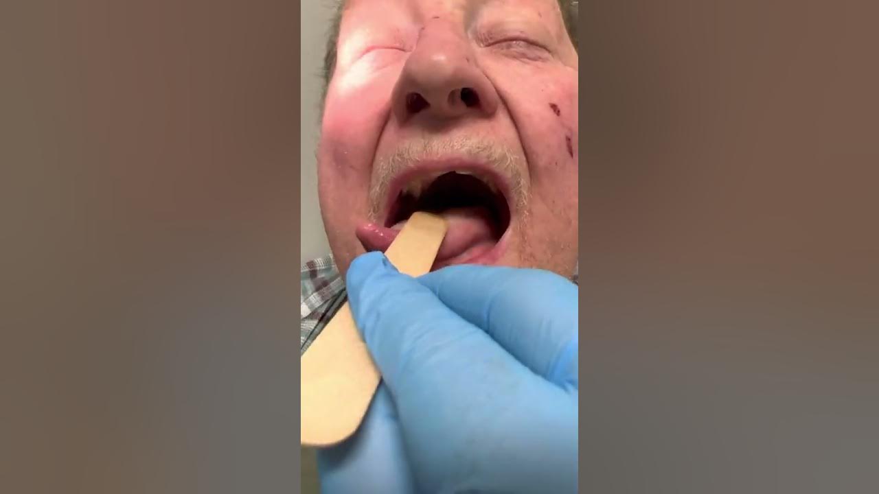 Tongue ulcers treated with silver nitrate YouTube