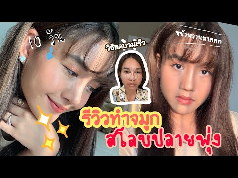 รีวิวทำจมูกทรงใบเฟิร์น สโลบปลายพุ่ง+หยดน้ำนิดๆ เจ็บไหม? 7วันหายบวมไวมากกับคุณหมอเชาว์[Runnie review]