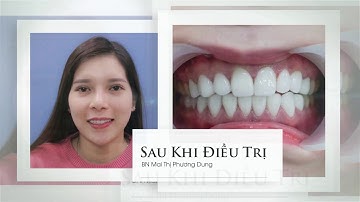 Nguyen Phuong Dung - Răng sứ thẩm mỹ
