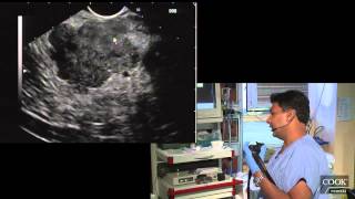 Pancreatic Tail Mass Primary vs Pancreatic Met FNA - Dr. Anand Sahai MD