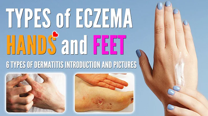 Types of Eczema on Hands and Feet | Hands and Feet Dermatitis Types with Pictures