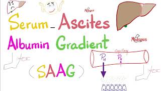 Serum Ascites Albumin Gradient (SAAG) | Peritoneal Effusion | Lab 🧪