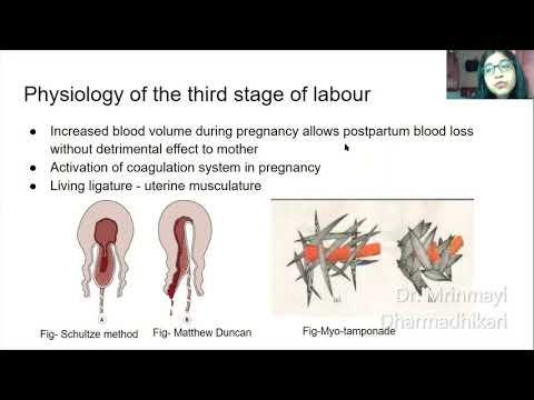 Postpartum Hemorrhage Part 1- Lost time can never be found again- By Dr. Mrinmayi Dharmadhikari
