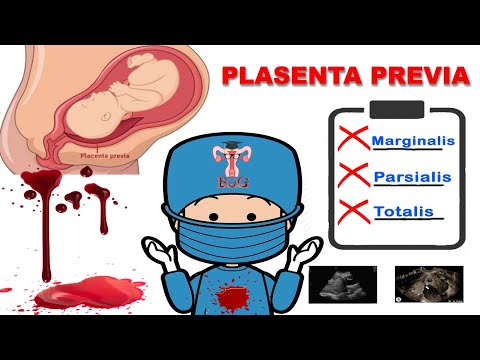 Plasenta previa - Update klasifikasi dan penatalaksaan plasenta previa