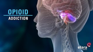 What is Opioid Addiction? Animation Video Answers the Question.