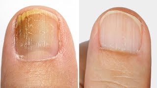 Untapped Natural Remedies for Toenail Fungus Relief!