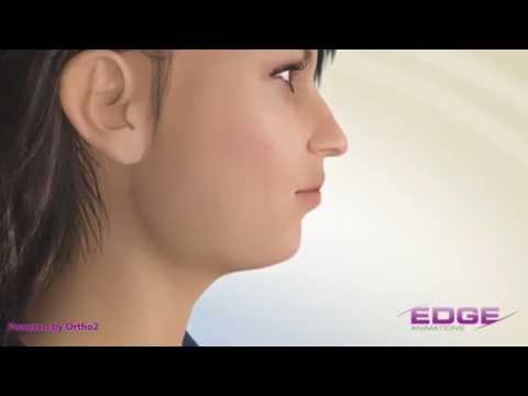 ორთოდონტია - გენიოპლასტიკა - Genioplasty