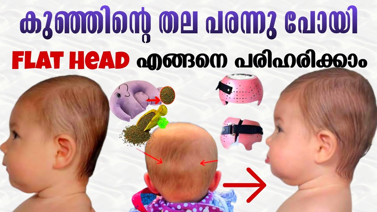 കുഞ്ഞിൻ്റെ തല പരന്നു പോയാൽ എന്ത് ചെയ്യും|Flat Head prevention and treatment for baby head shape