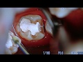 親知らずの虫歯をドックベストセメントで治療！　顕微鏡歯科治療！