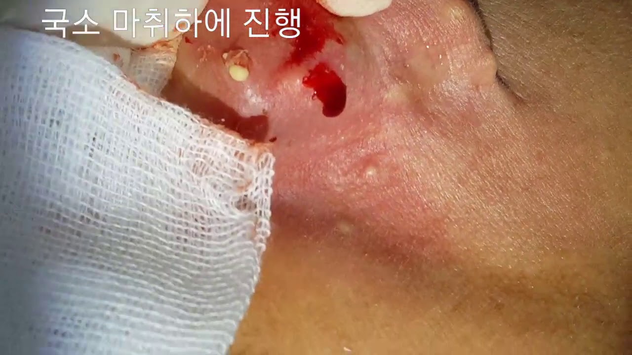 피지낭종 , 표피낭종 steatocystoma  not infected