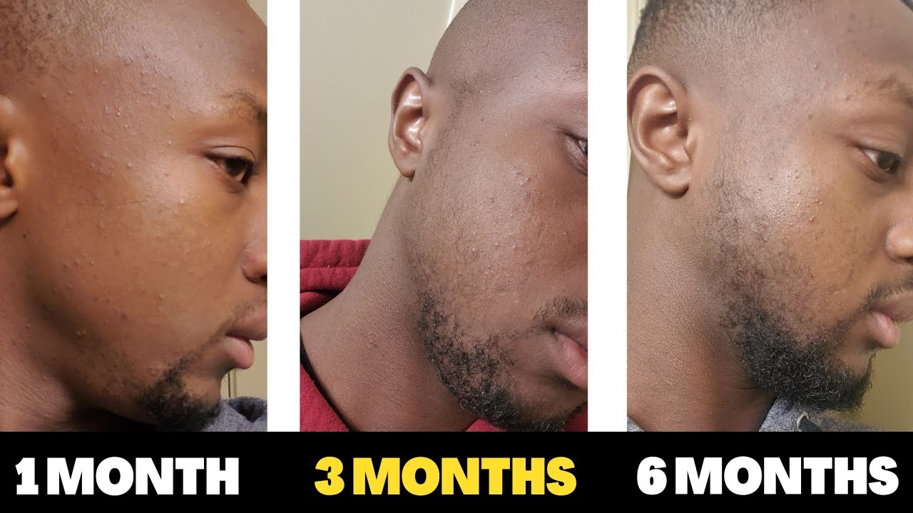My Message to all Slow Gainers | Minoxidil Beard Journey