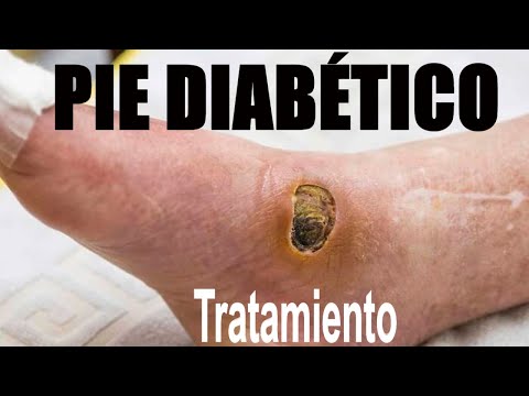 Vídeo: Dolor Y úlceras En El Pie Diabético: Causas Y Tratamientos