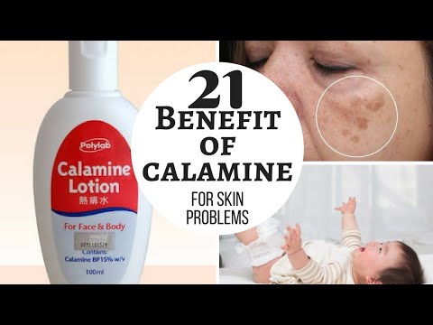 Video: Brug Af Calamine Lotion: Fordele, Anvendelse Og Potentielle Bivirkninger