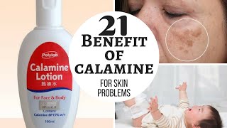 CALAMINE lotion | Lacto calamine lotion uses in detail, side effects