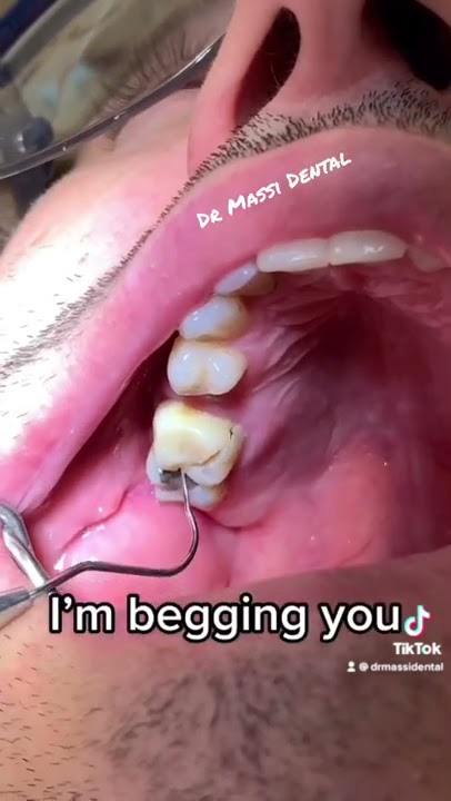 Broken tooth!#video #tiktok #trending #viral #fyp #fyp #youtubeshorts #youtube #shorts #love #like