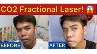CO2 Fractional Laser | Treatment para matanggal ang Acne Scars, Lines and Dark Spots (Philippines)
