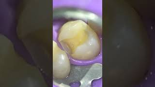 Tooth Filling { Cavity Removal + Bonding }