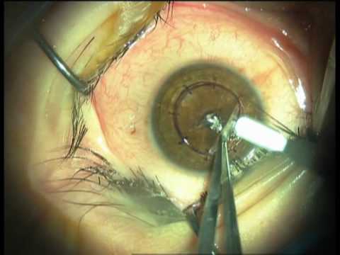 Deep Anterior Lamellar Keratoplasty, big bubble, DR MUSTAFA NAL