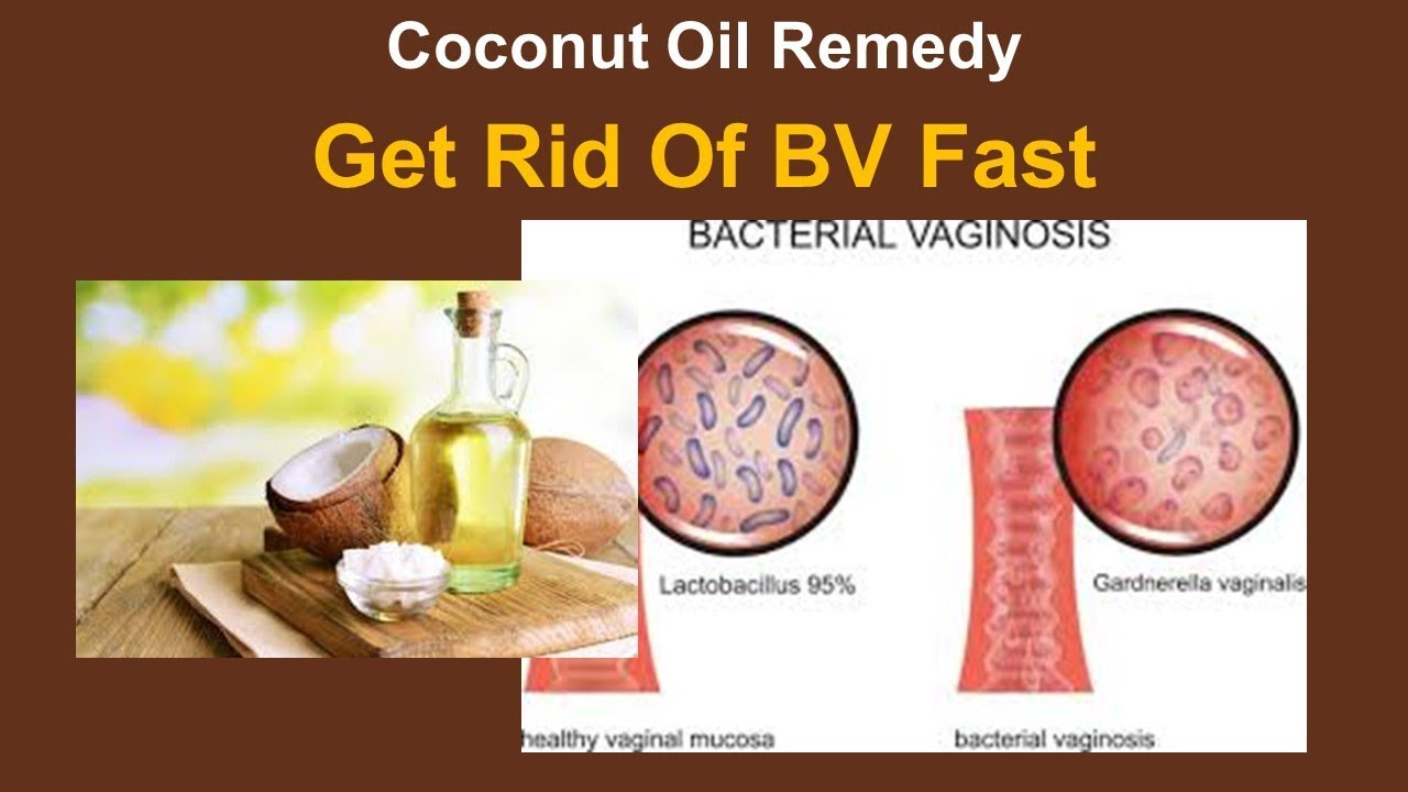 Natural Ways To Get Rid Of Bv Fast Coconut Oil Remedy Youtube