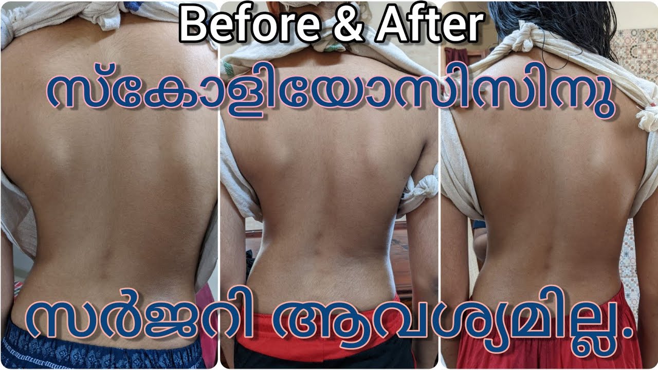 Idiopathic scoliosis do not need surgery|Veda Ayurgram