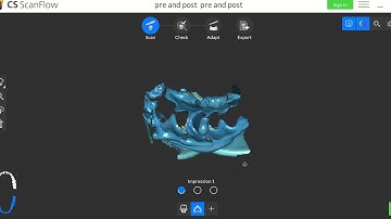 hybrid merging of a Carestream Dental IO scan with an impression scan