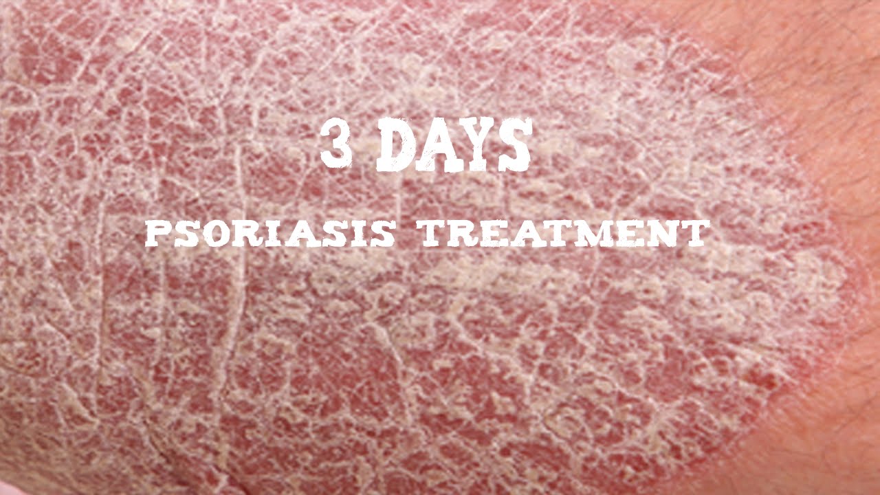 Plaque And Scalp Psoriasis Treatment Natural Skin Treatment Youtube