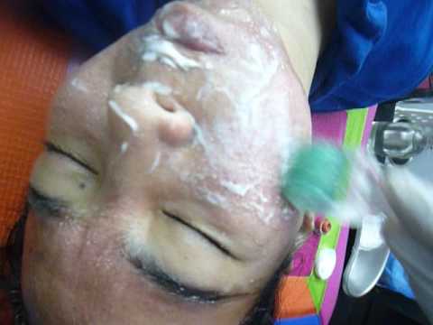 dermaroller-blood's-not-wiped-off-it-has-platelets-for-skin-rejuvenation.-kpg-gajah-girl