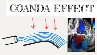 Coanda effect in cardiology