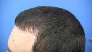 Dr.Hasson 3339 Grafts- One session