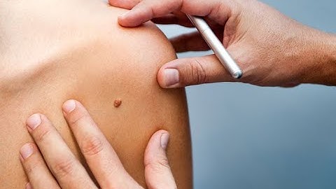 Excision  of Lesion CPT code - simplify medical coding