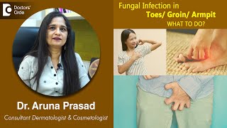 FUNGAL INFECTION in your TOES/ GROIN/ ARMPIT? Causes, Symptoms and Treatment - Dr. Aruna Prasad