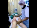 熱血Dr横谷＠湘南美容クリニック大阪梅田院院長　脂肪吸引　左大腿後＋お尻から1000ml