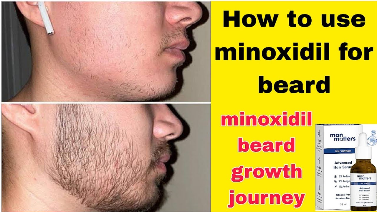 how to use minoxidil for beard | minoxidil beard growth journey - YouTube