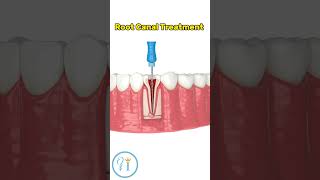 Root canal treatment-this is how it looks like.🦷😁#dentist #rootcanal  #dentalclinic #smile  #teeth