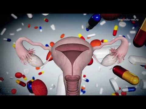 Ce sunt supozitoarele vaginale antiinflamatorii în ginecologie?