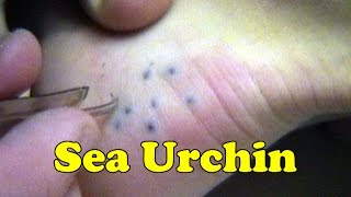Sea Urchin Spine Sting Removal Attempt  Maui Hawaii  Daredevil Girl
