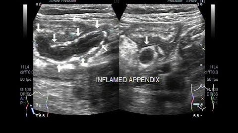 Ultrasound Video showing probe handling in a case of Inflamed Appendix.