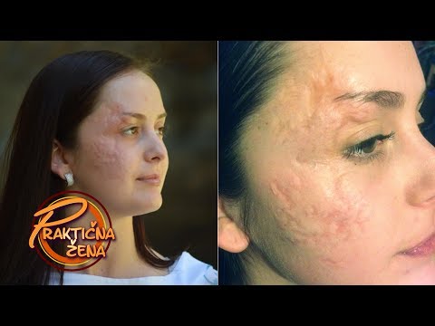 Praktična žena - Uklanjanje ožiljka sa lica gledateljke Jelene