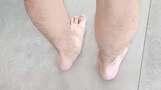 Tarsal Koalisyon Tarsal Coalition. Çocuk Ortopedisi