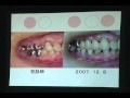 Part7~重度歯周病は抜歯というのはホント？~歯周病をなくすシンポジウム