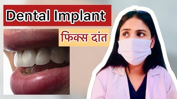 Real daant Jaisa Dental Implant! | Dentist Explains Step by Step 🦷 #dentalimplants #denture #implant