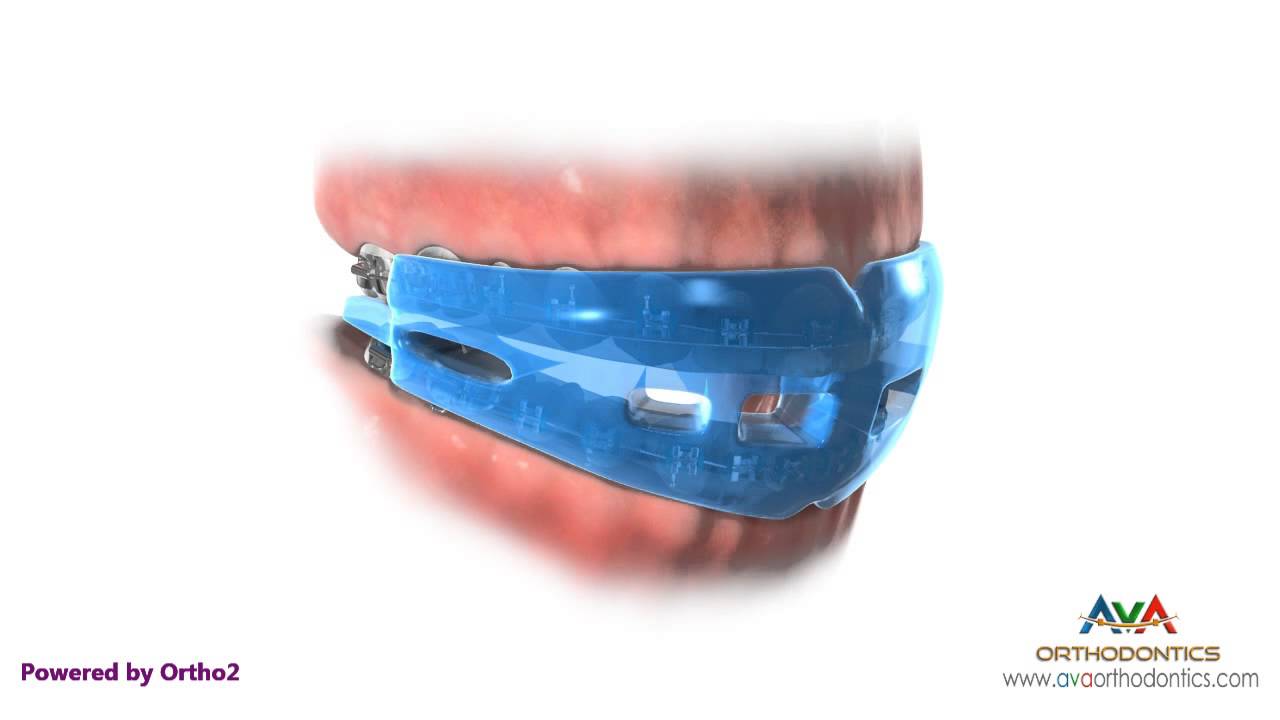 The Ultimate Guide to the Parts of Braces - Frey Orthodontics