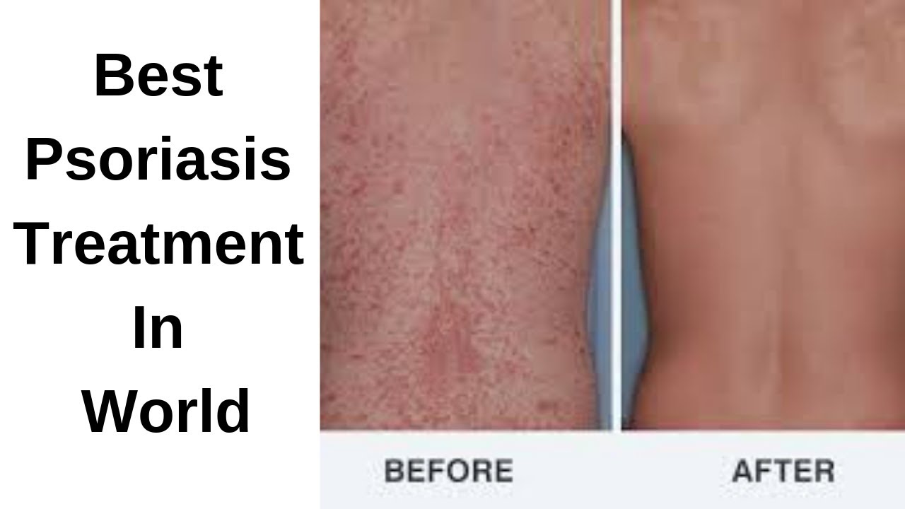 best psoriasis treatment in world