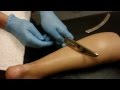 Graston Technique Treatment for Achilles Tendon Injury - Bozeman, MT Certified Sports Chiropractor