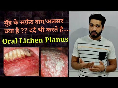 Video: Môže lichen planus spôsobiť rakovinu?