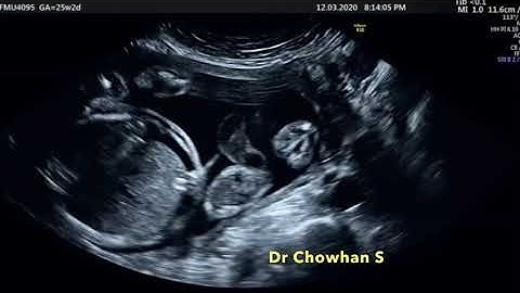Fetal Blood Transfusion By Dr S Chowhan, Fetal Medicine Specialist