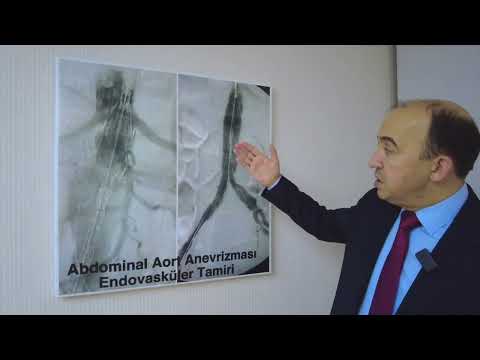 Video: Abdominal aort anevrizması