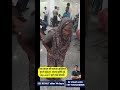 14 days recovery after hip replacement surgery by Dr Jitesh Jain, Jaipur